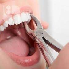 کشیدن دندان عقبی (بدون جراحی) دکتر سید علی کمونه در کرج 1