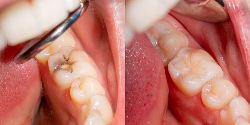 پرکردن دندان سه سطحی با کامپوزیت آلمانی دکتر نسیبه افنداک در بوشهر 1