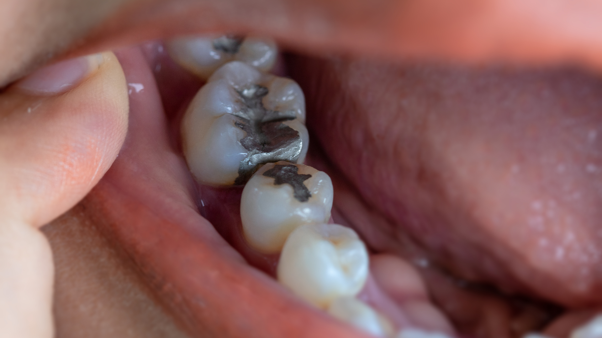 بیلدآپ (بازسازی) دندان با آمالگام ایرانی دکتر علی سجودی خوشابی در تهران 1