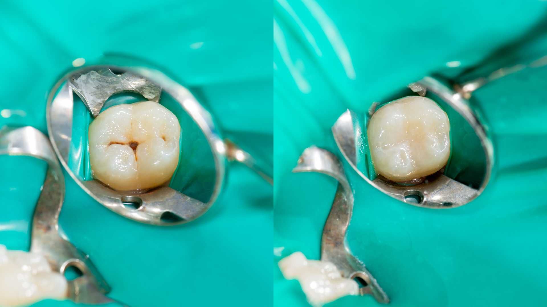 پرکردن دندان یک سطحی با آمالگام ایرانی