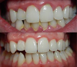 بیلدآپ (بازسازی) دندان با کامپوزیت ژاپنی