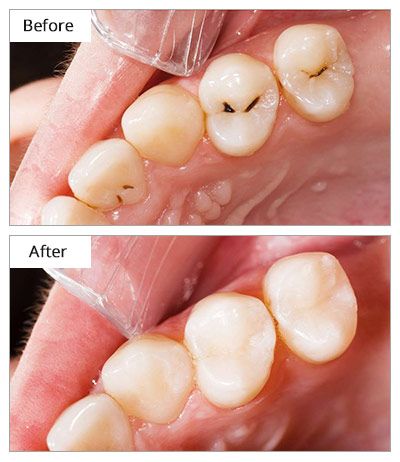پرکردن دندان شیری سه سطحی با آمالگام ایرانی