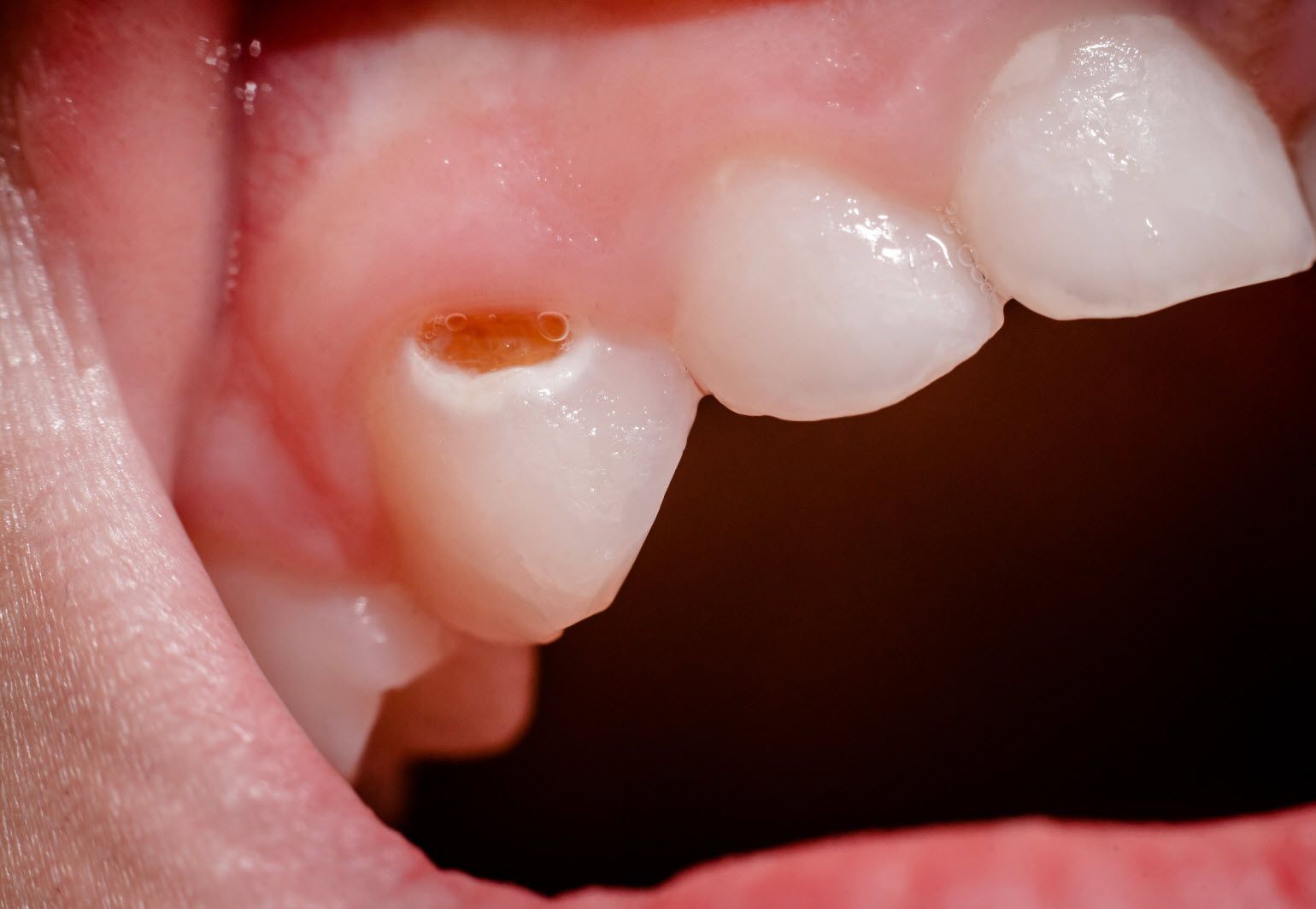 پر کردن دندان یک سطحی با کامپوزیت سوئیسی دکتر فاطمه فقیهی در شیراز 1