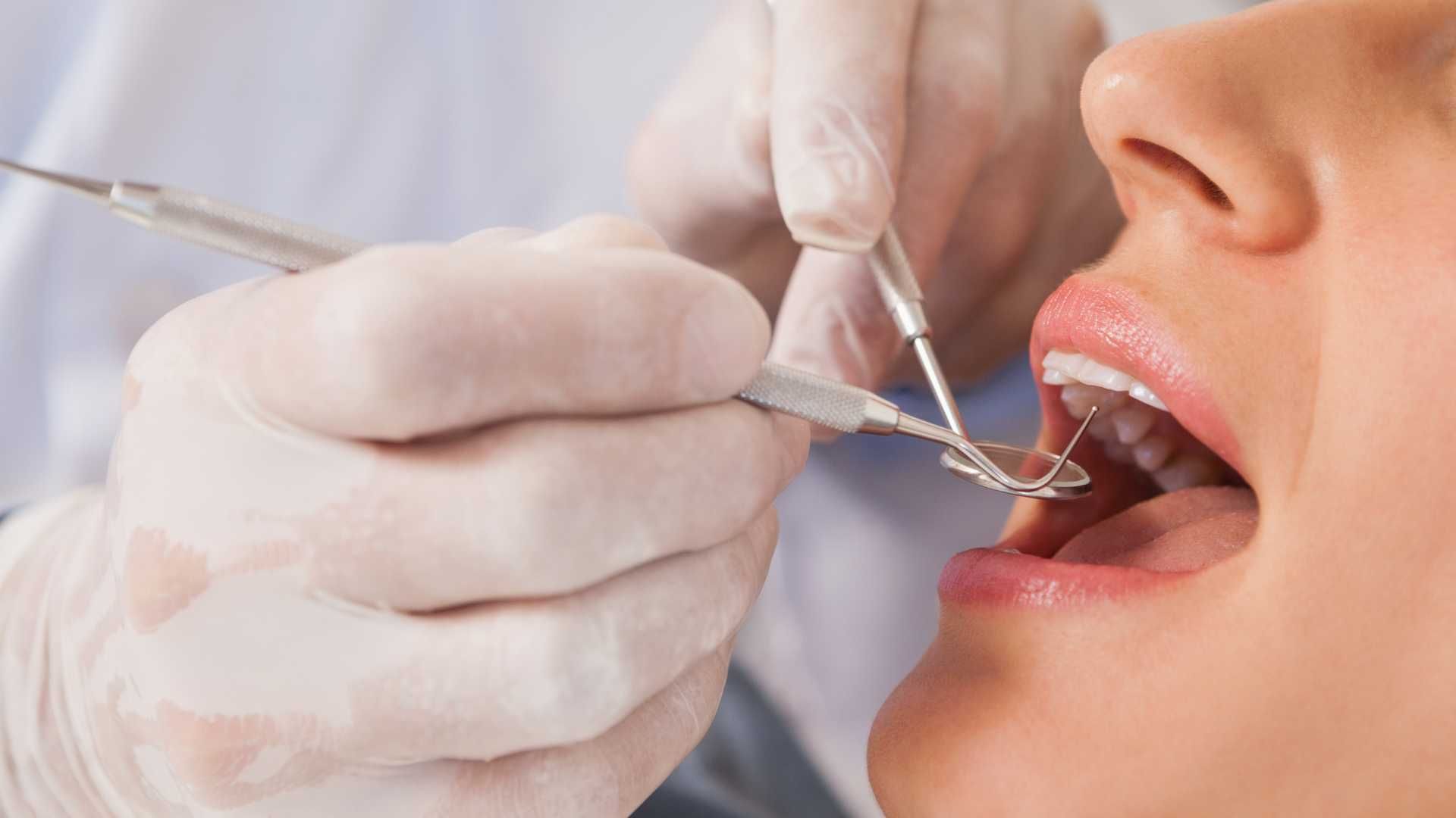 پرکردن دندان سه سطحی با کامپوزیت آمریکایی دکتر سهیلا طائی در تهران 1