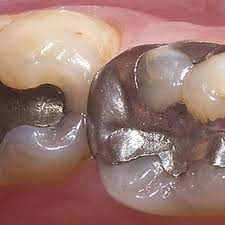 بیلدآپ (بازسازی) دندان با آمالگام ایرانی دکتر آزاده سیدمیرزائی در کرج 1
