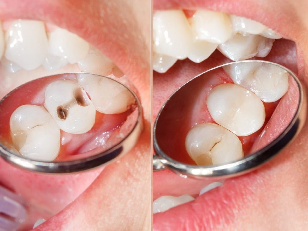 پر کردن دندان سه سطحی با کامپوزیت سوئیسی دکتر فاطمه فقیهی در شیراز 1