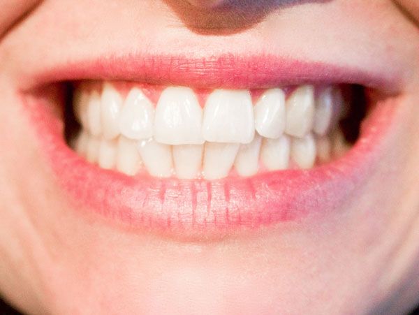 بیلدآپ (بازسازی) دندان با کامپوزیت ژاپنی دکتر نگار عطاءالهی در شیراز 1