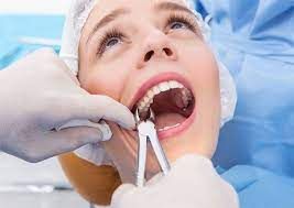 کشیدن دندان عقل (بدون جراحی)