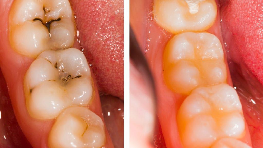 پرکردن دندان سه سطحی با کامپوزیت ژاپنی
