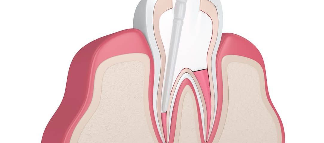 پالپکتومی دندان شیری (هر دندان)