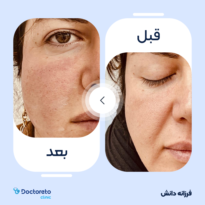 تزریق ژل خط خنده با برند آلیاکسین (1cc)