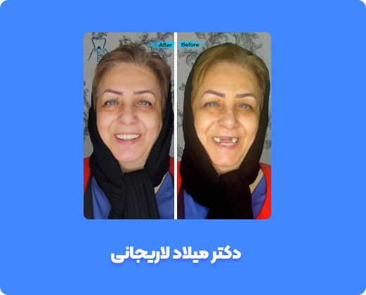 انواع روکش دندان