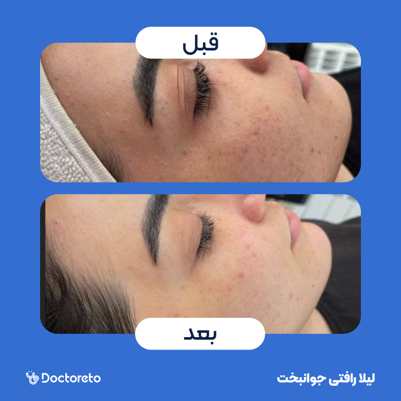 فیشیال (پاکسازی) کل صورت با دستگاه هیدروفشیال (1 جلسه)