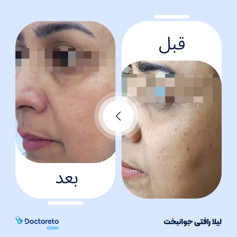 جوانسازی صورت با پلاسماتراپی (هر جلسه) دکتر لیلا رافتی جوانبخت در مشهد 4