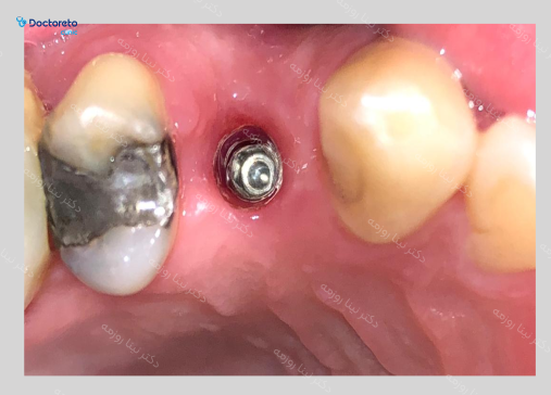 ایمپلنت CMI کره ای با روکش (هر واحد) دکتر نینا روزمه در تهران 3