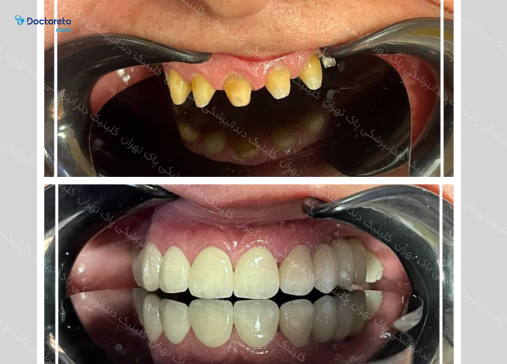 ایمپلنت دندان با روکش کلینیک دندانپزشکی پاک تهران در تهران 12
