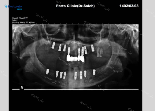 ایمپلنت SIC سوئیسی بدون روکش (هر واحد) دکتر علی امیری در تهران 3