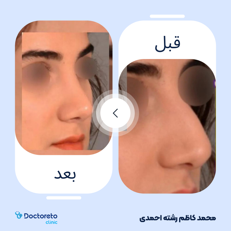 جراحی انحراف بینی (سپتوپلاستی)