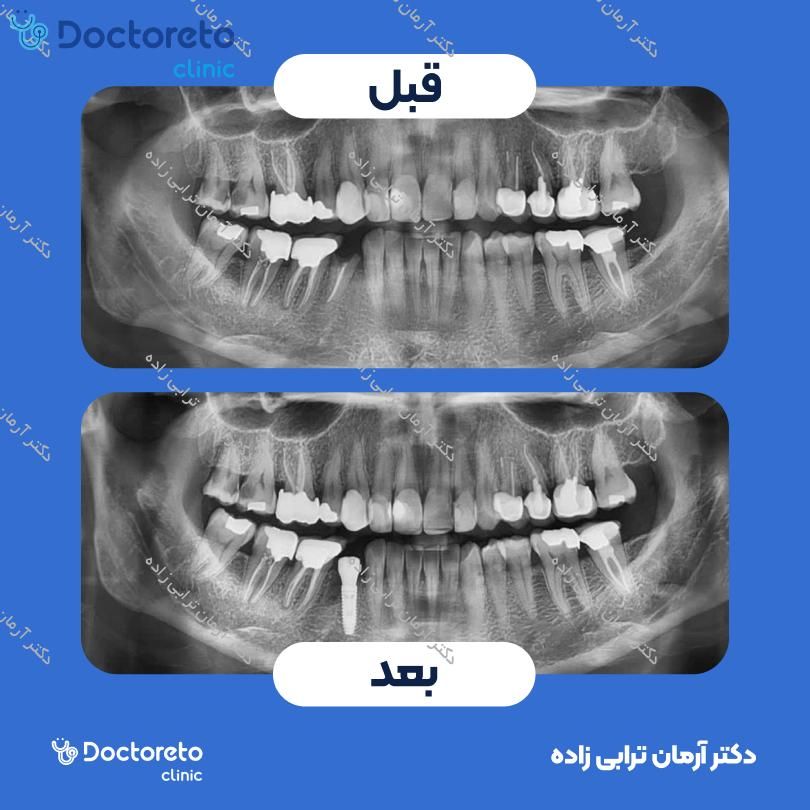 جراحی پیوند استخوان پیشرفته با تگ (هرواحد) دکتر آرمان ترابی زاده در تهران 7