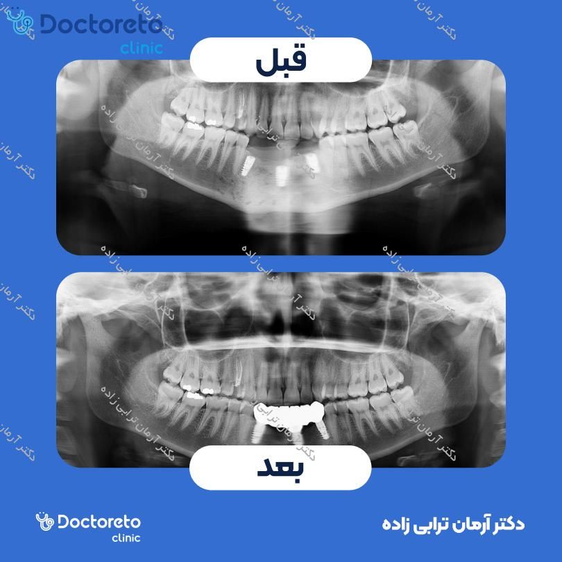 ایمپلنت اشترومن ساده تیتانیومی سوئیسی با روکش (هر واحد) دکتر آرمان ترابی زاده در تهران 2