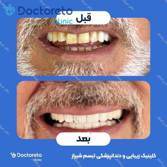 روکش ایمپلنت دیجیتال دنتیس کره ای (هر واحد) دکتر مریم زراعتکار در شیراز 6