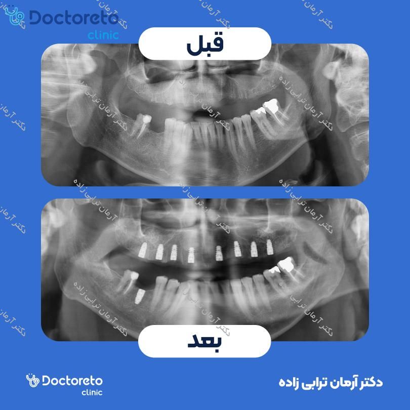 ایمپلنت کره ای dio با روکش (هر واحد) دکتر آرمان ترابی زاده در تهران 11