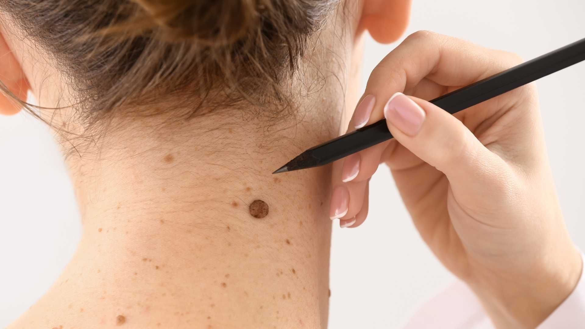 برداشتن ضایعات پوستی (skin tags) با دستگاه RF (ده عدد)