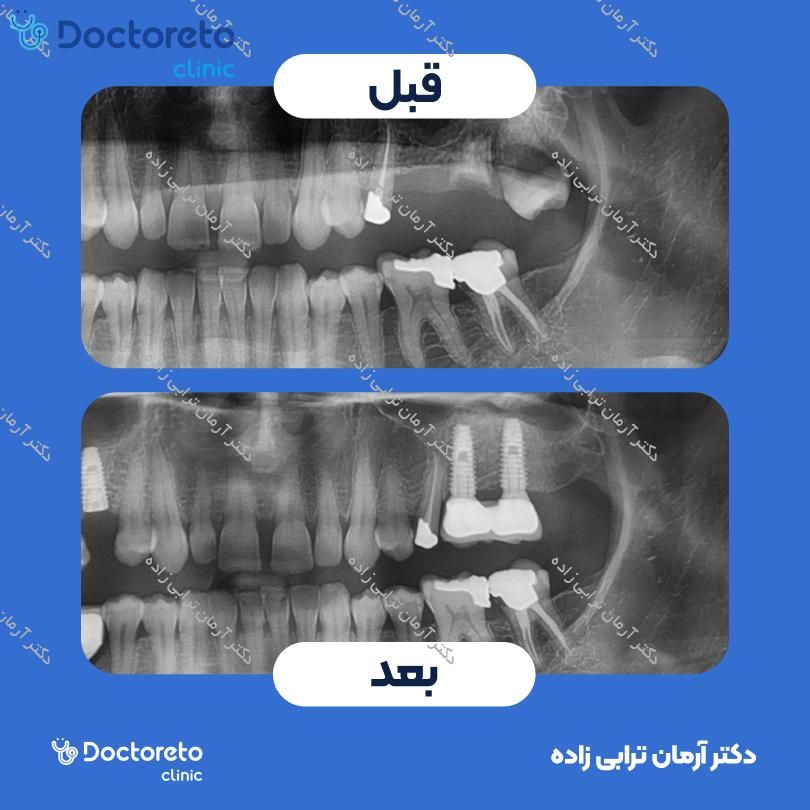 جراحی پیوند استخوان از چانه (هرواحد) دکتر آرمان ترابی زاده در تهران 14