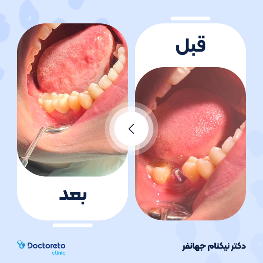 ایمپلنت کره ای اسنوکن با روکش زیرکونیا