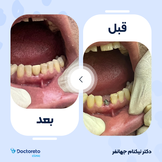 ایمپلنت اسپانیا جی ام آی (GMI) با روکش زیرکونیا دکتر نیکنام جهانفر در کرج 6