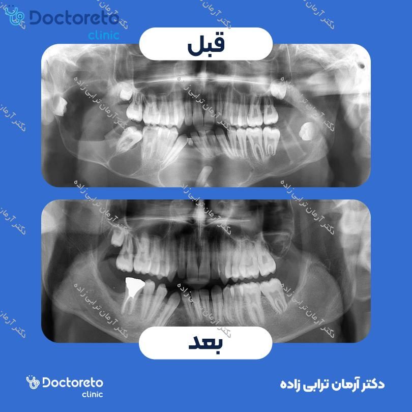 جراحی پیوند استخوان از راموس (هرواحد) دکتر آرمان ترابی زاده در تهران 17