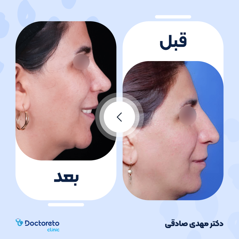 جراحی انحراف بینی (سپتوپلاستی) دکتر مهدی صادقی در اصفهان 4