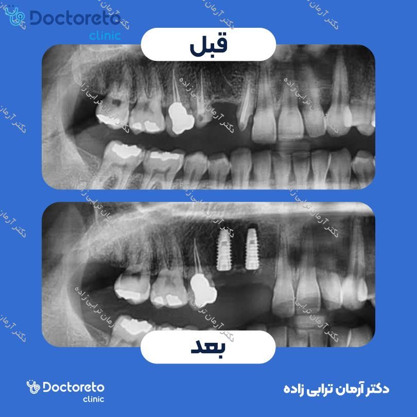 ایمپلنت icx آلمانی با روکش (هر واحد) دکتر آرمان ترابی زاده در تهران 7