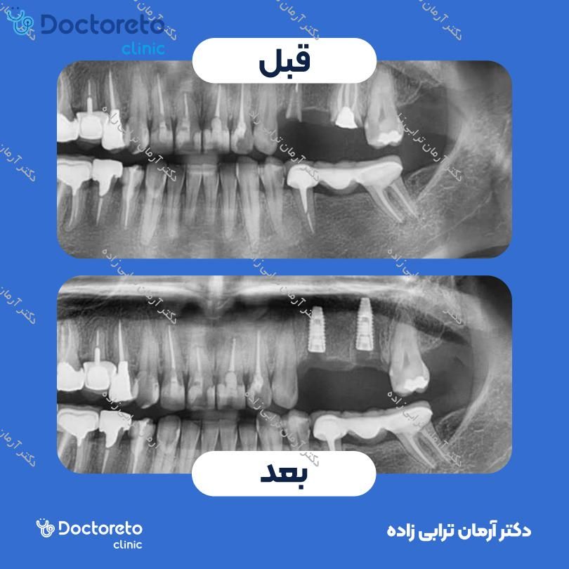 جراحی پیوند استخوان از چانه (هرواحد) دکتر آرمان ترابی زاده در تهران 18