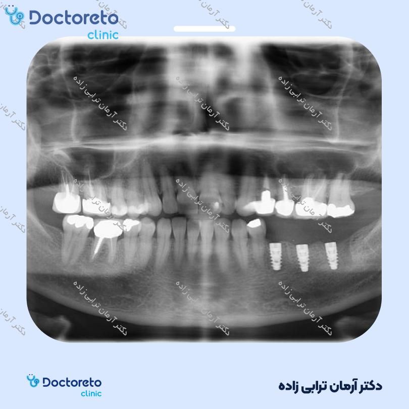 جراحی پیوند استخوان پیشرفته با تگ (هرواحد) دکتر آرمان ترابی زاده در تهران 11