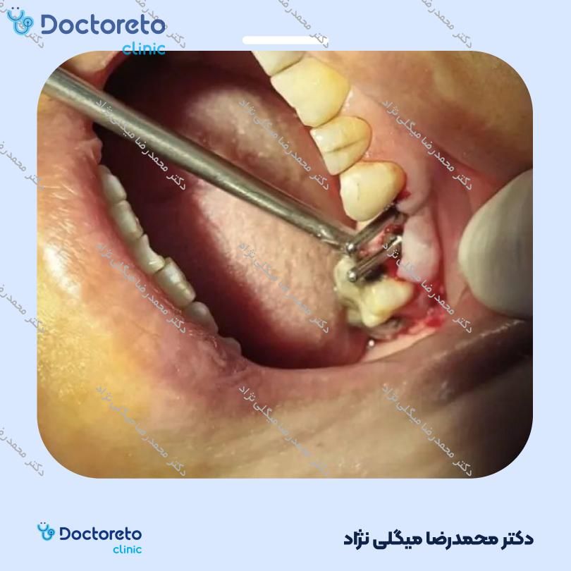 ایمپلنت دیو کره ای با روکش (هر واحد) دکتر محمدرضا میگلی نژاد در شیراز 6