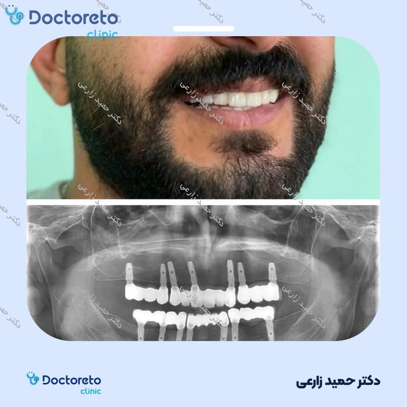 ایمپلنت DIO کره ای با روکش (هر واحد)