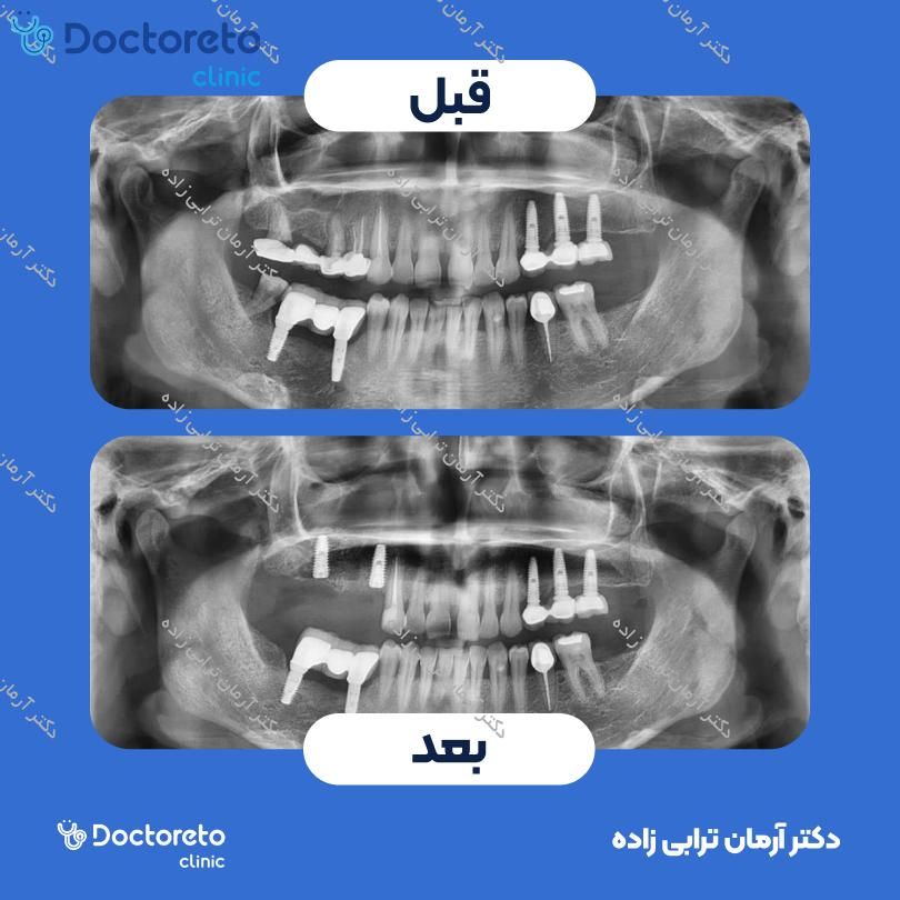 ایمپلنت اشترومن BLX active سوئیسی با روکش (هر واحد) دکتر آرمان ترابی زاده در تهران 17