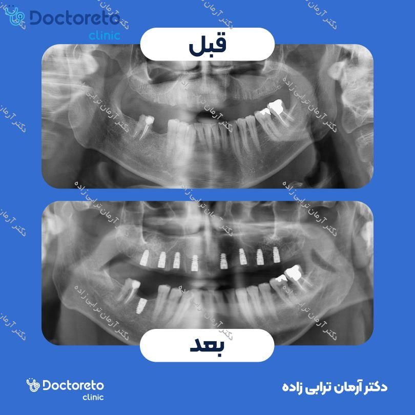 جراحی پیوند استخوان از چانه (هرواحد) دکتر آرمان ترابی زاده در تهران 9