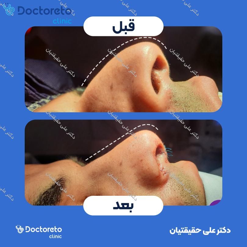 عمل جراحی مجدد زیبایی بینی (رینوپلاستی) دکتر علی حقیقتیان در شیراز 5