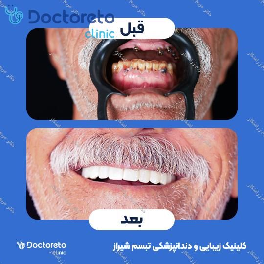 روکش ایمپلنت دیجیتال دنتیس کره ای (هر واحد)