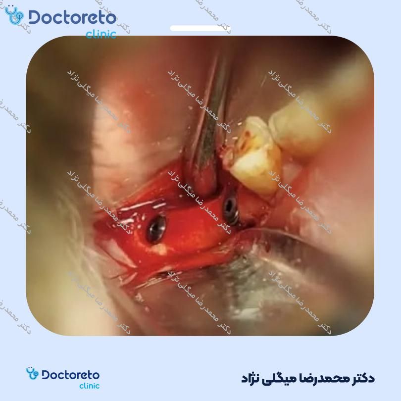 ایمپلنت دیو کره ای با روکش (هر واحد) دکتر محمدرضا میگلی نژاد در شیراز 2