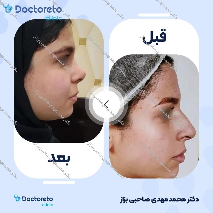 عمل زیبایی بینی (رینوپلاستی) دکتر محمدمهدی صاحبی بزاز در اهواز 10