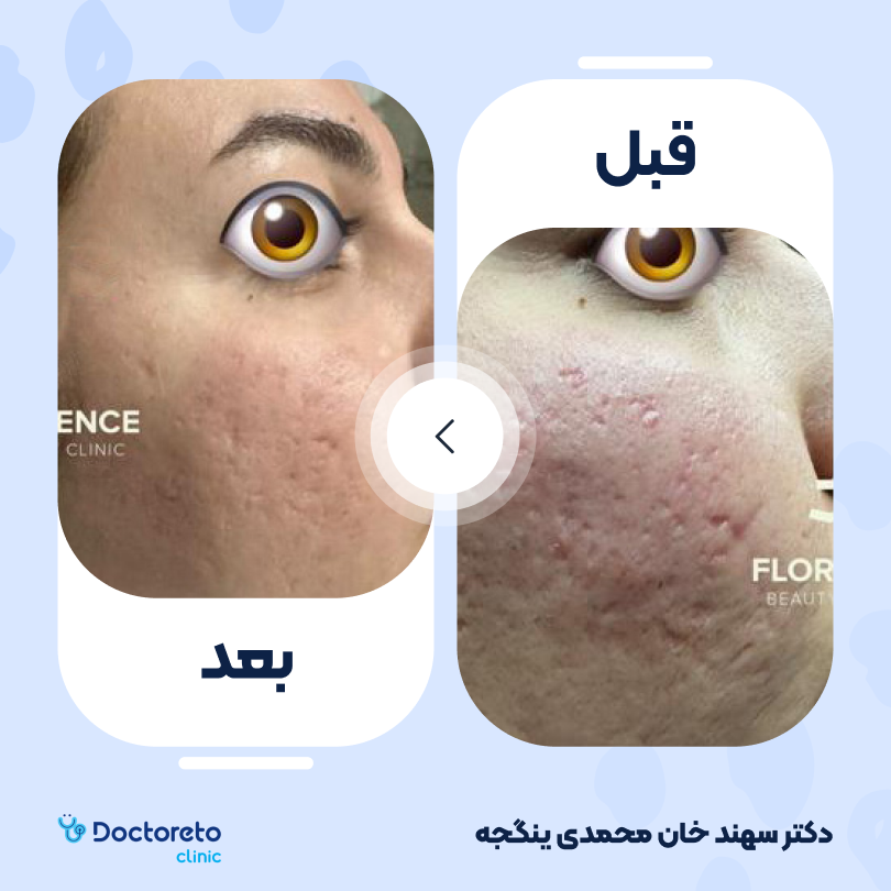 جوانسازی صورت با مزوژل رمدیوم آکوا (هر جلسه)