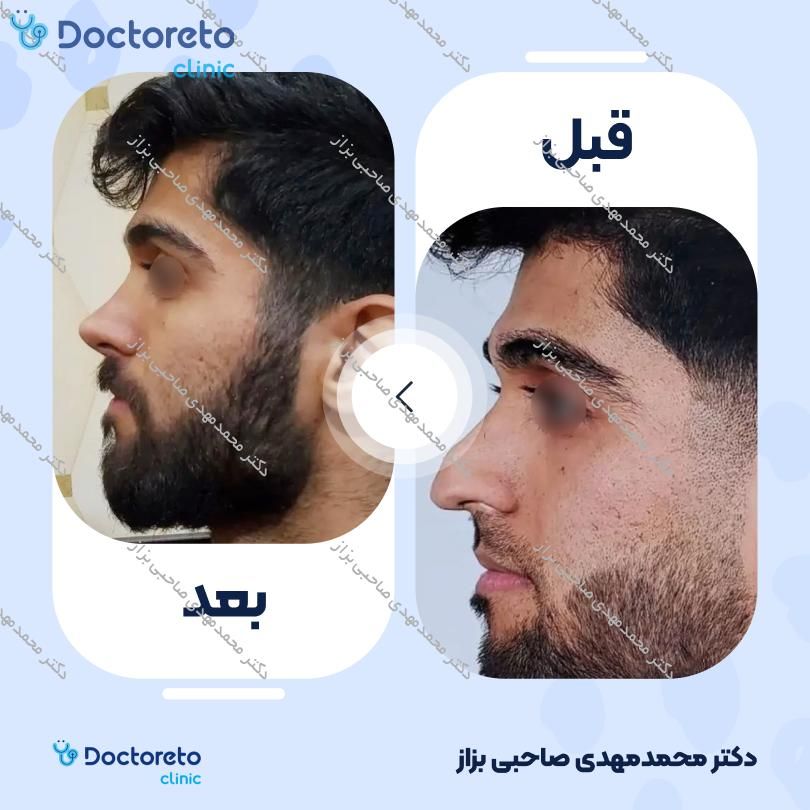 عمل جراحی مجدد زیبایی بینی (رینوپلاستی) دکتر محمدمهدی صاحبی بزاز در اهواز 8