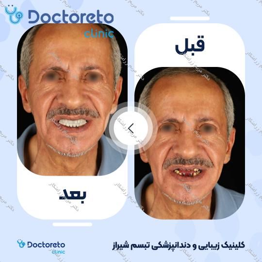 روکش ایمپلنت دیجیتال دنتیس کره ای (هر واحد) دکتر مریم زراعتکار در شیراز 4