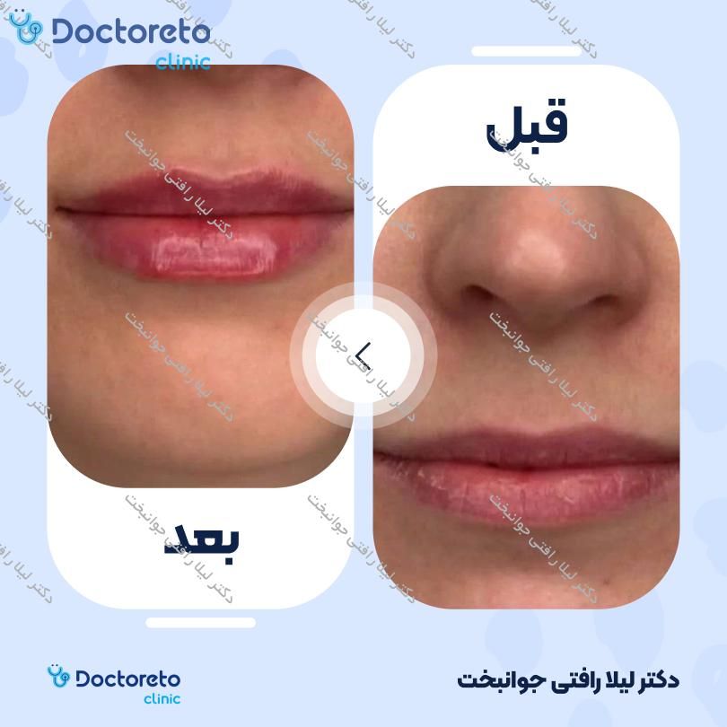 تزریق ژل لب با برند نورامیس (1cc) دکتر لیلا رافتی جوانبخت در مشهد 2