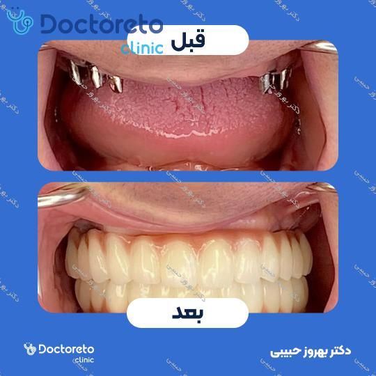 ایمپلنت آلمانی بایوتری (bio3) با روکش تمام سرامیک ( هر واحد ) دکتر بهروز حبیبی در تهران 12