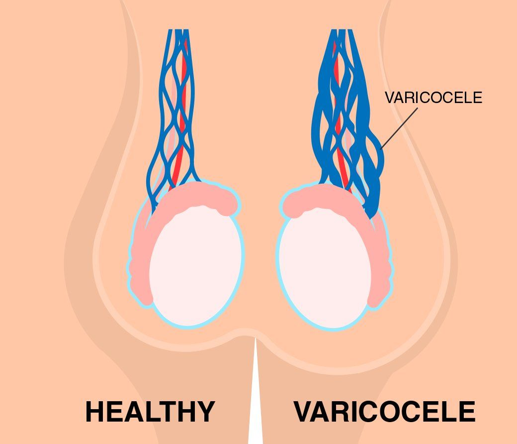 جراحی واریکوسل