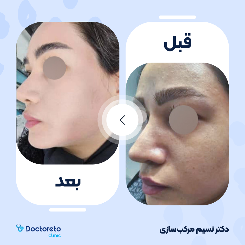 جوانسازی صورت با لیزر rf فرکشنال (یک جلسه) دکتر نسیم مرکب سازی در تهران 4